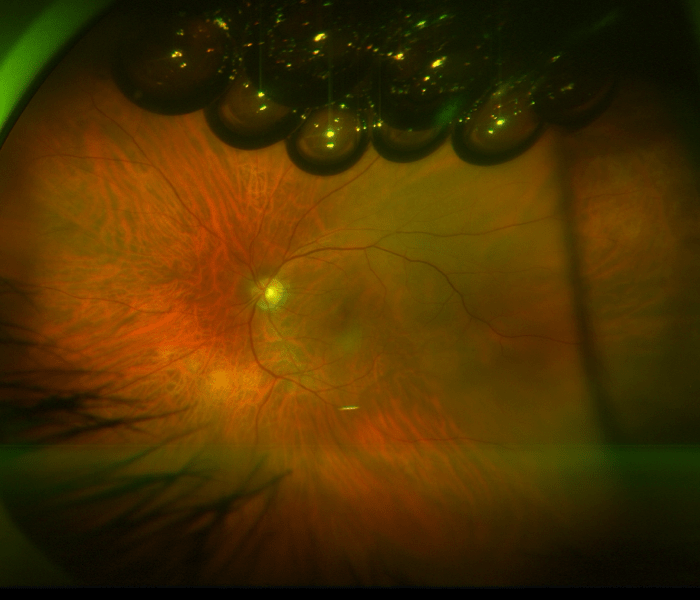 Retinal Tears and Detachments